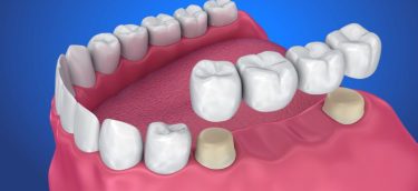 Dental-crown-and-Bridge-768x476.jpg.optimal