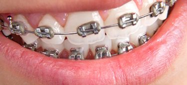 orthodontic-braces