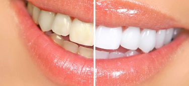 teeth-whitening-1