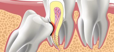 wisdom-tooth-removal-montreal-maxillovendome